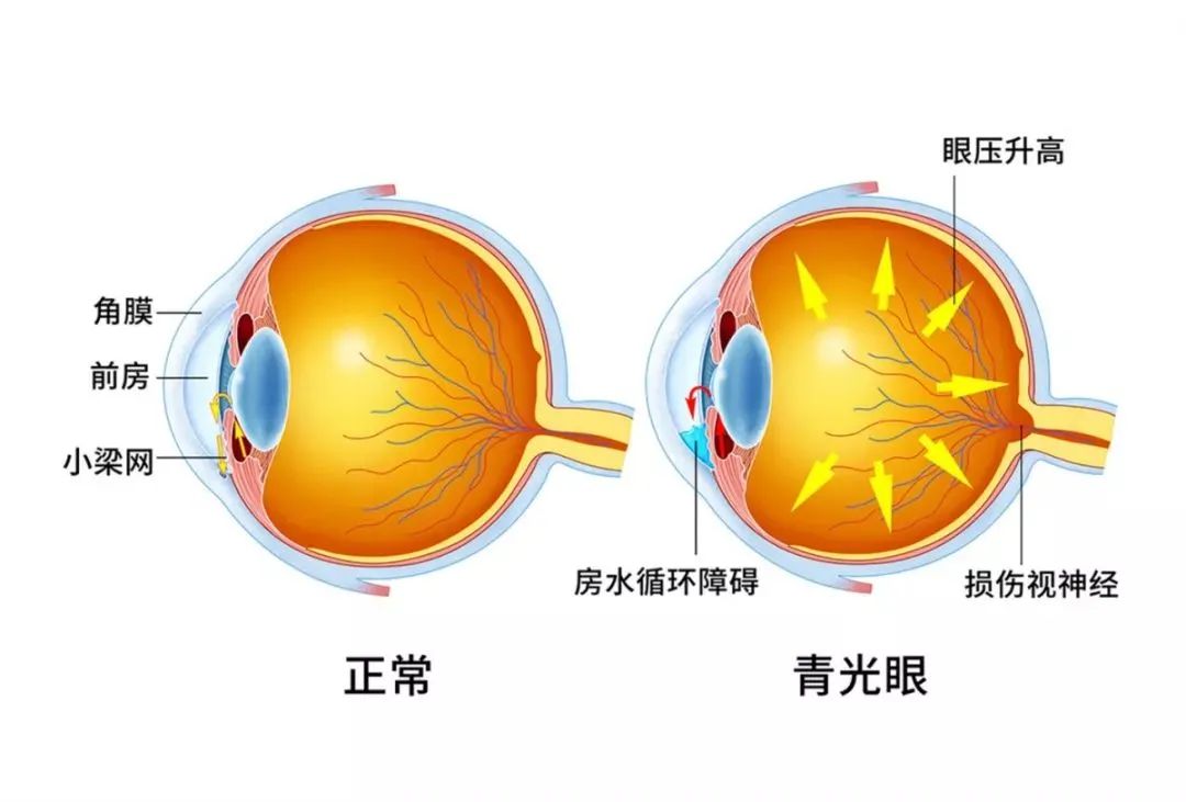 青光眼，正常