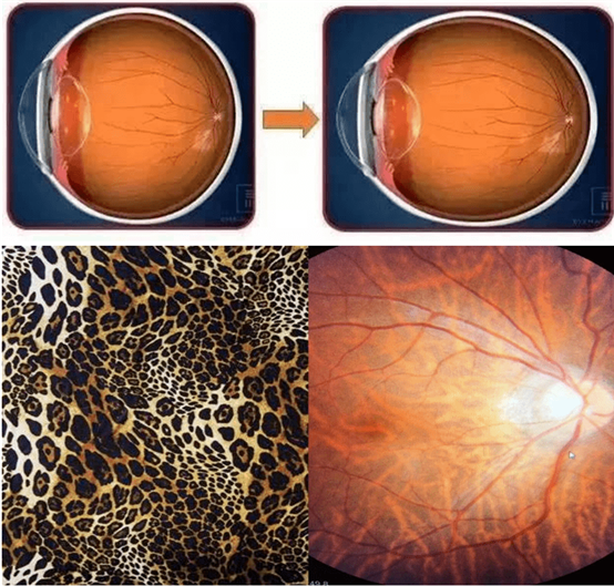 豹紋狀眼底演變